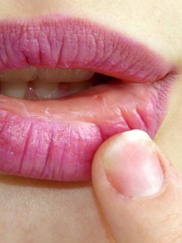 Cracked lips are a hindrance to beauty. Use these tips daily